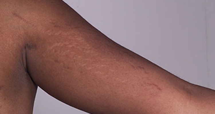 All About Stretch Marks